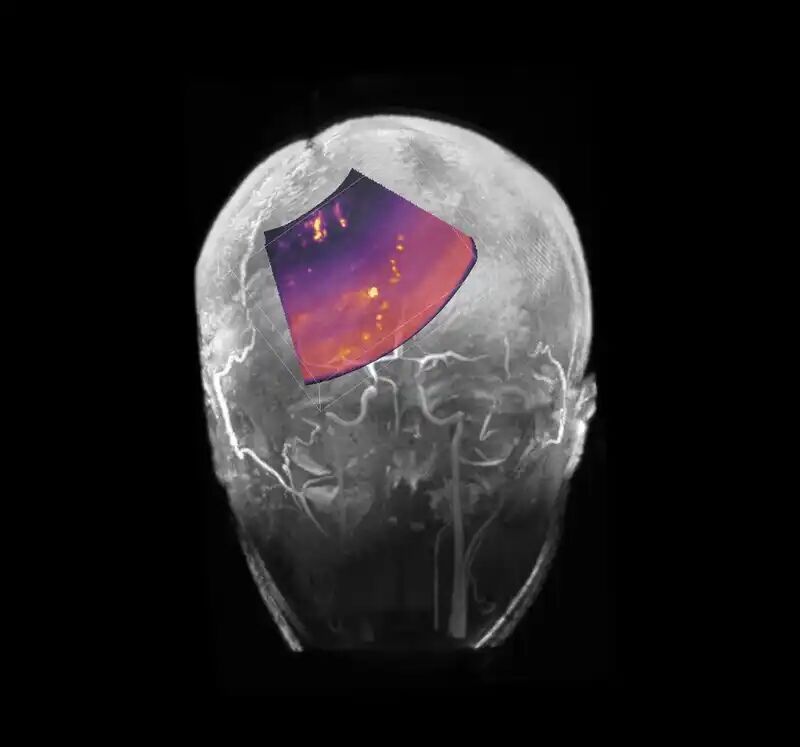 图片[32]-马斯克「脑机第一人」首爆！不开颅在线升级，永生代码已写入-AI Express News