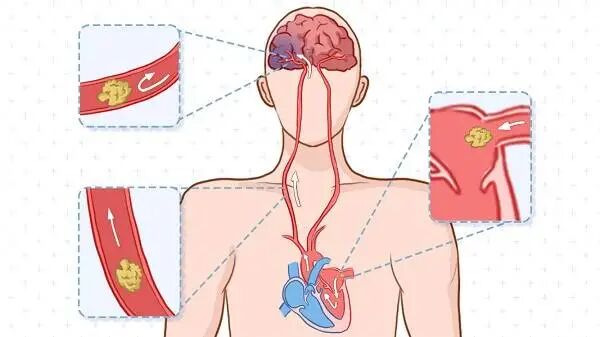 图片[5]-专访苹果医学家：房颤患者，为什么应该戴一块 Apple Watch？-AI Express News